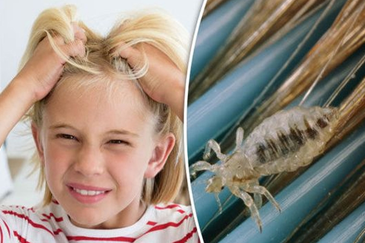 Does olive oil kill lice?